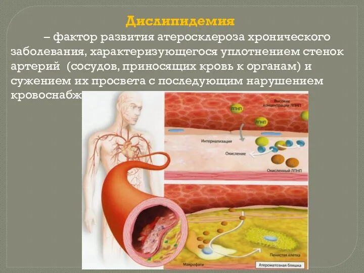 Дислипидемия – фактор развития атеросклероза хронического заболевания, характеризующегося уплотнением стенок артерий (сосудов, приносящих