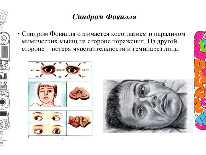 Синдром Фовилля Синдром Фовилля отличается косоглазием и параличом мимических мышц