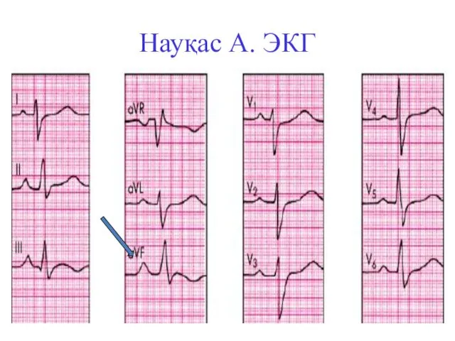 Науқас А. ЭКГ