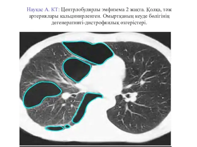 Науқас А. КТ: Центрлобулярлы эмфизема 2 жақта. Қолқа, тәж артериялары кальцинирленген. Омыртқаның кеуде бөлігінің дегенеративті-дистрофяилық өзгерістері.