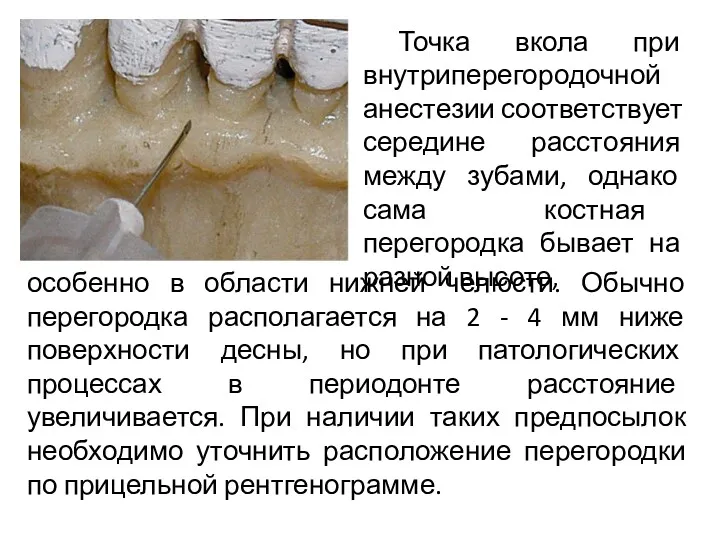 Точка вкола при внутриперегородочной анестезии соответствует середине расстояния между зубами, однако сама костная