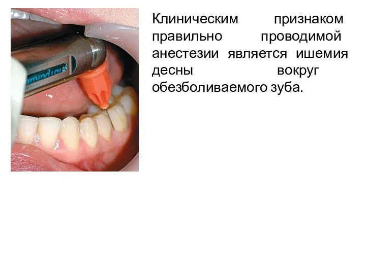 Клиническим признаком правильно проводимой анестезии является ишемия десны вокруг обезболиваемого зуба.