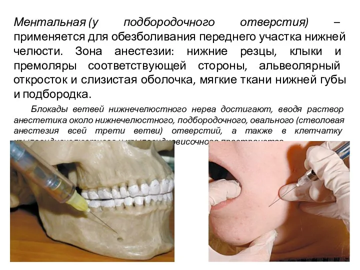 Ментальная (у подбородочного отверстия) – применяется для обезболивания переднего участка нижней челюсти. Зона