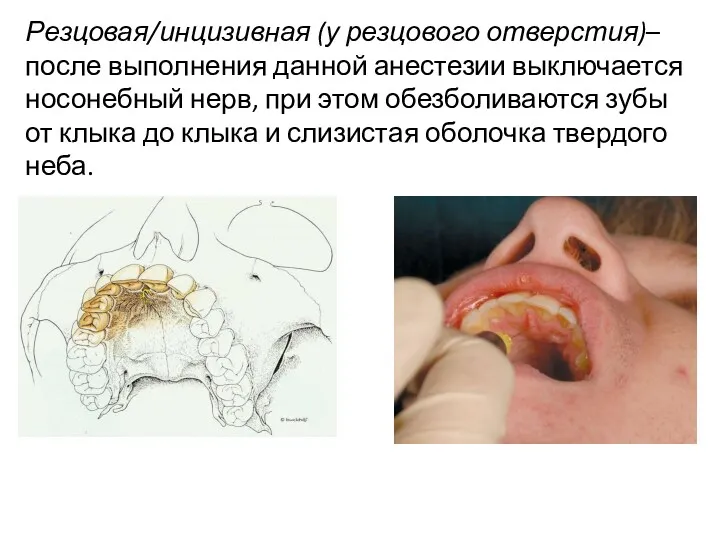 Резцовая/инцизивная (у резцового отверстия)– после выполнения данной анестезии выключается носонебный нерв, при этом