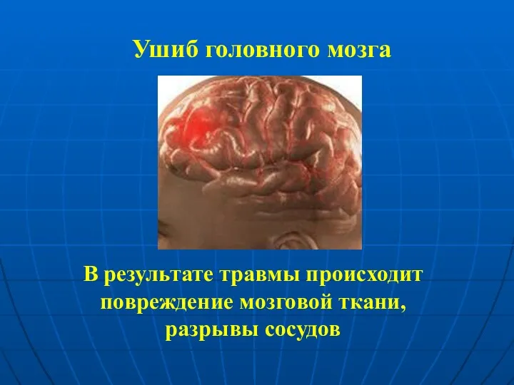 Ушиб головного мозга В результате травмы происходит повреждение мозговой ткани, разрывы сосудов
