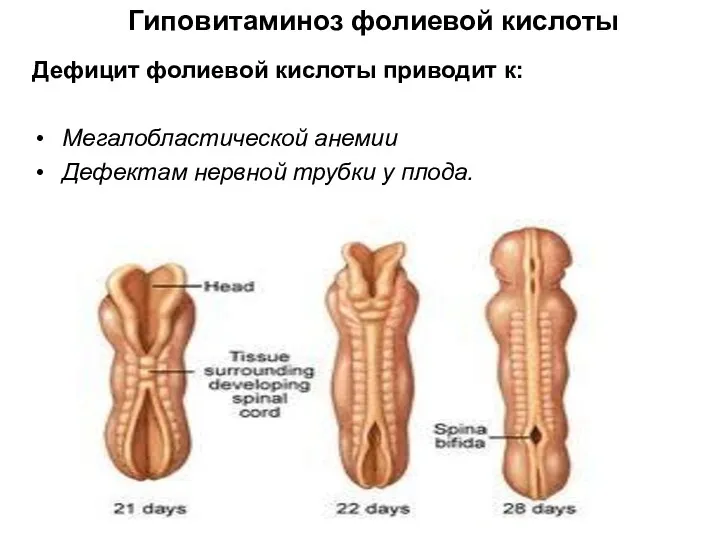 Мегалобластической анемии Дефектам нервной трубки у плода. Дефицит фолиевой кислоты приводит к: Гиповитаминоз фолиевой кислоты