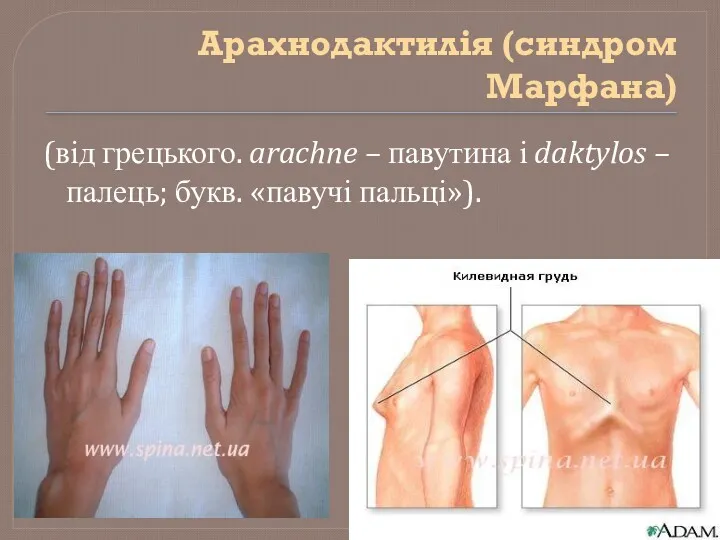 Арахнодактилія (синдром Марфана) (від грецького. arachne – павутина і daktylos – палець; букв. «павучі пальці»).