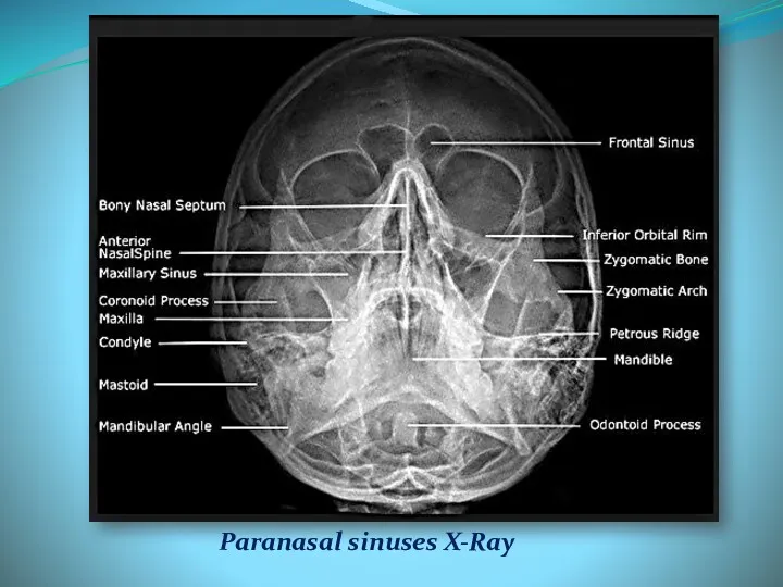 Paranasal sinuses X-Ray