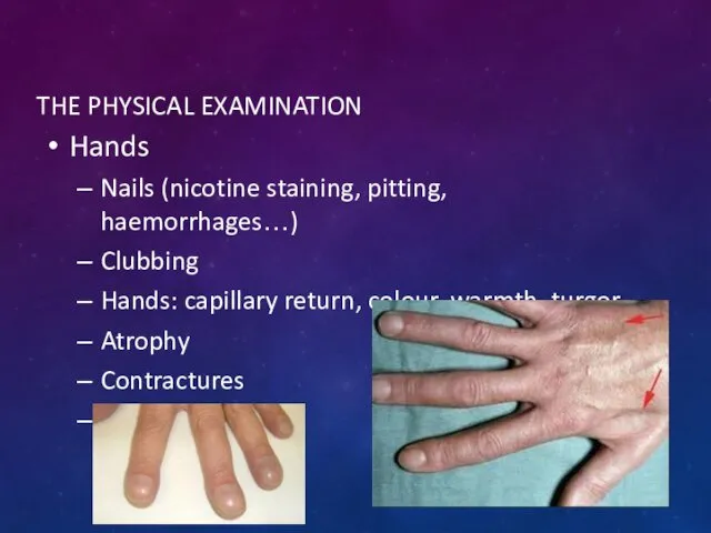 THE PHYSICAL EXAMINATION Hands Nails (nicotine staining, pitting, haemorrhages…) Clubbing