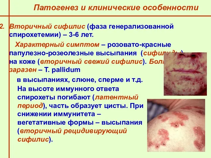 Патогенез и клинические особенности Вторичный сифилис (фаза генерализованной спирохетемии) –