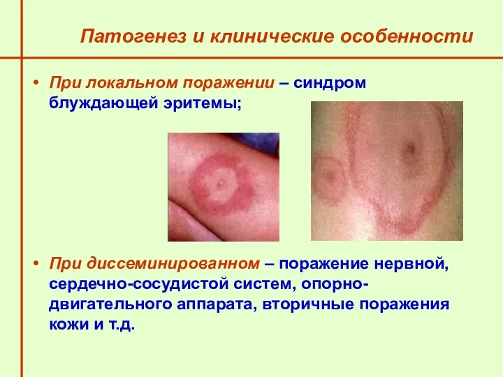 Патогенез и клинические особенности При локальном поражении – синдром блуждающей