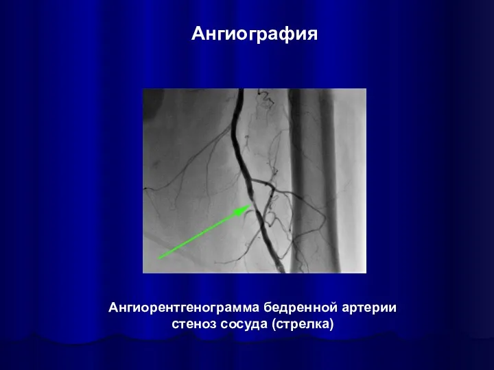 Ангиография Ангиорентгенограмма бедренной артерии стеноз сосуда (стрелка)