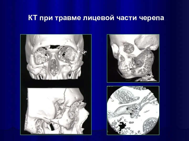 КТ при травме лицевой части черепа