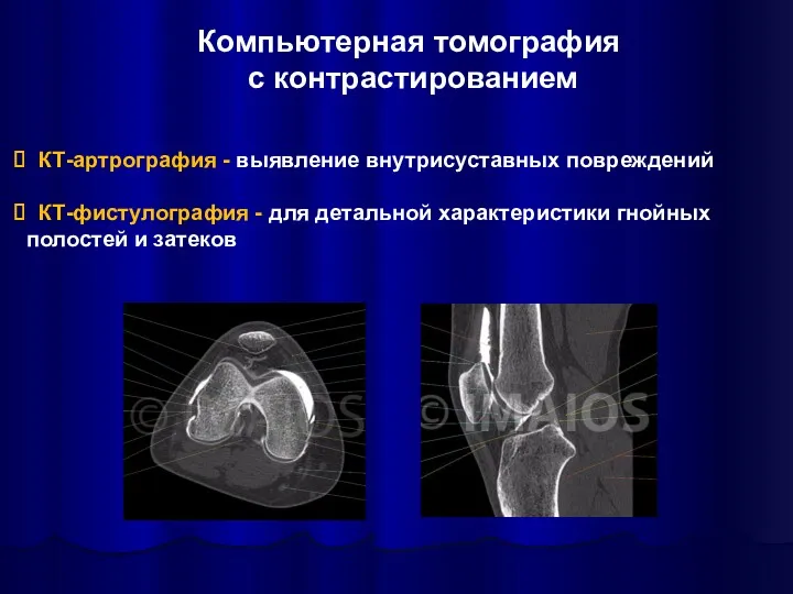 Компьютерная томография с контрастированием КТ-артрография - выявление внутрисуставных повреждений КТ-фистулография