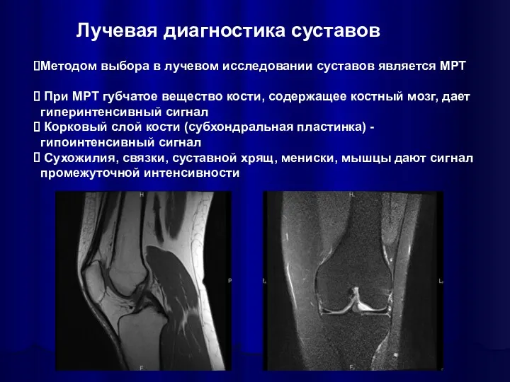 Методом выбора в лучевом исследовании суставов является МРТ При МРТ