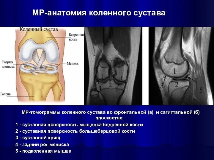 МР-томограммы коленного сустава во фронтальной (а) и сагиттальной (б) плоскостях: