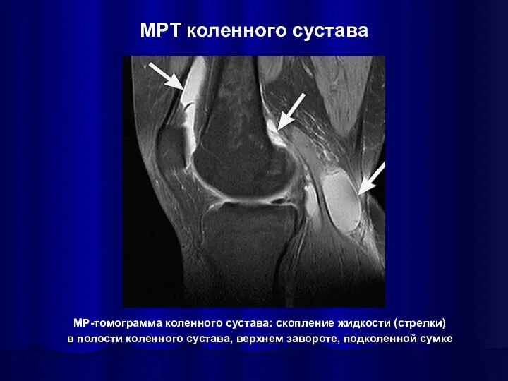 МР-томограмма коленного сустава: скопление жидкости (стрелки) в полости коленного сустава,