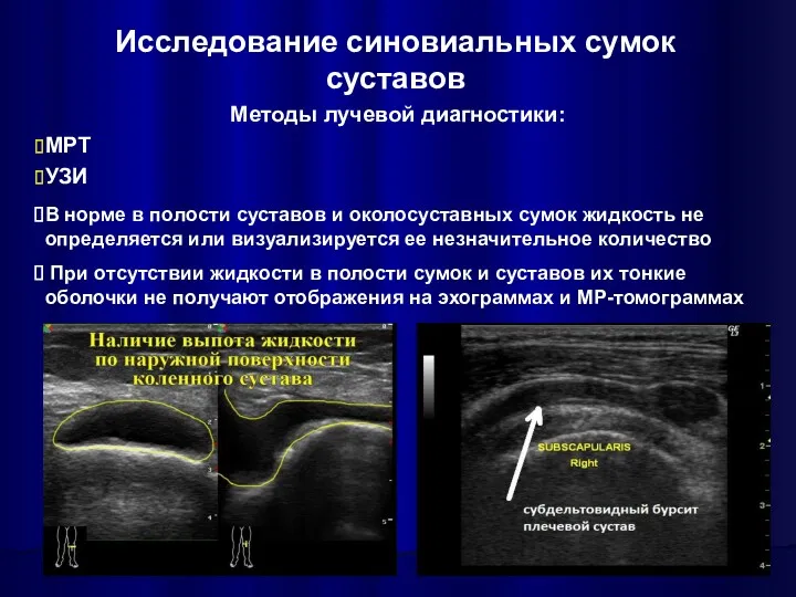 Исследование синовиальных сумок суставов Методы лучевой диагностики: МРТ УЗИ В