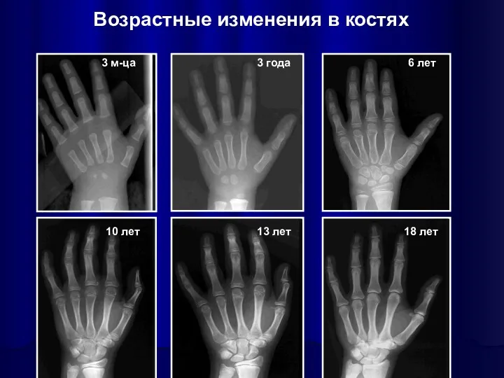 Возрастные изменения в костях 3 м-ца 3 года 6 лет 10 лет 13 лет 18 лет