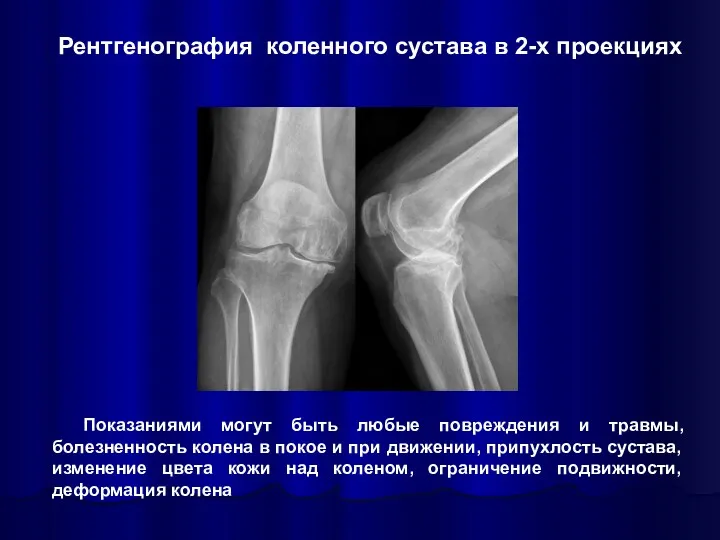 Рентгенография коленного сустава в 2-х проекциях Показаниями могут быть любые