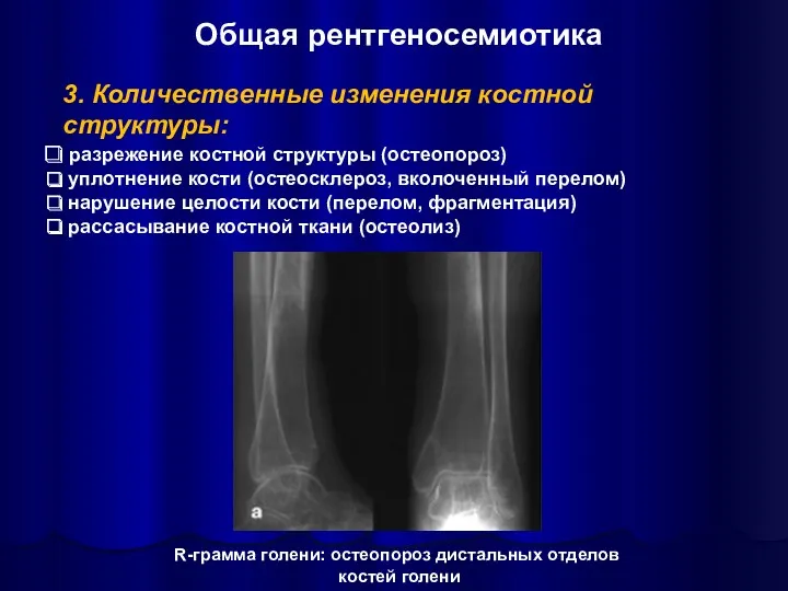 3. Количественные изменения костной структуры: разрежение костной структуры (остеопороз) уплотнение