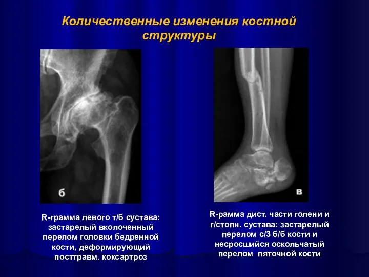 R-рамма дист. части голени и г/стопн. сустава: застарелый перелом с/3