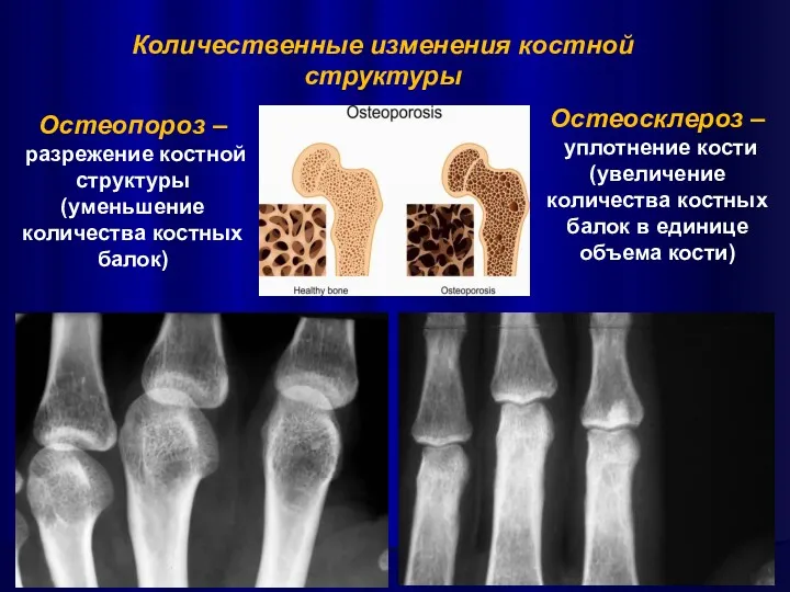 Остеосклероз – уплотнение кости (увеличение количества костных балок в единице