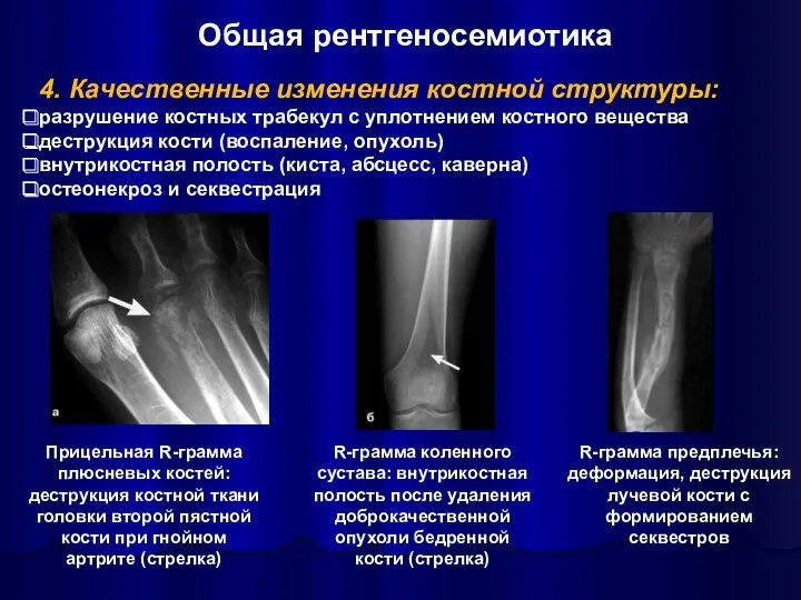 Общая рентгеносемиотика 4. Качественные изменения костной структуры: разрушение костных трабекул