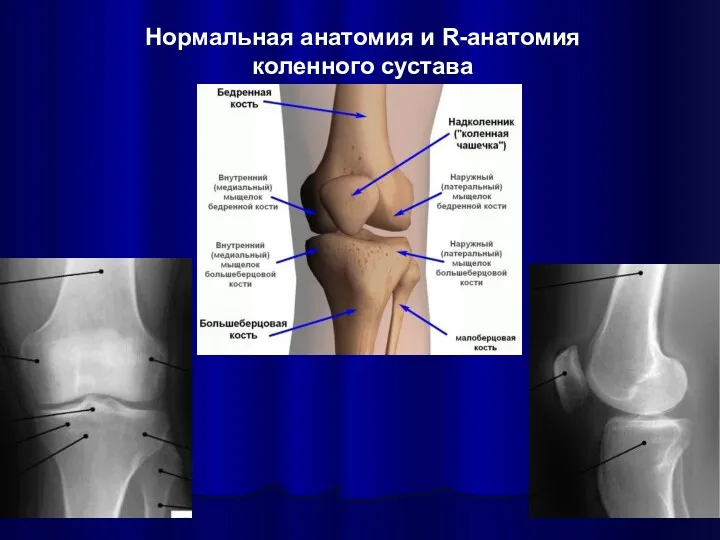 Нормальная анатомия и R-анатомия коленного сустава