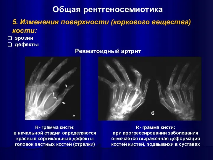 5. Изменения поверхности (коркового вещества) кости: эрозии дефекты Ревматоидный артрит