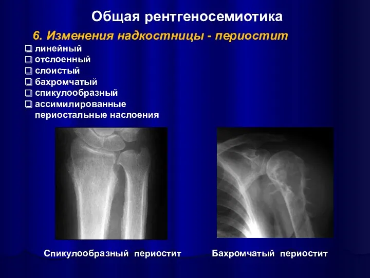 6. Изменения надкостницы - периостит линейный отслоенный слоистый бахромчатый спикулообразный