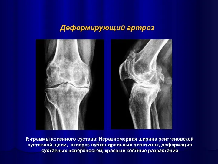R-граммы коленного сустава: Неравномерная ширина рентгеновской суставной щели, склероз субхондральных
