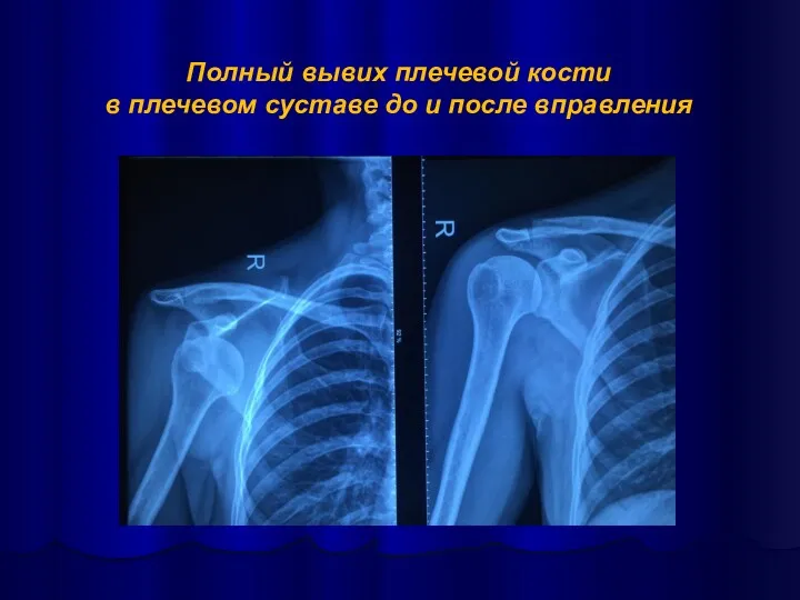 Полный вывих плечевой кости в плечевом суставе до и после вправления