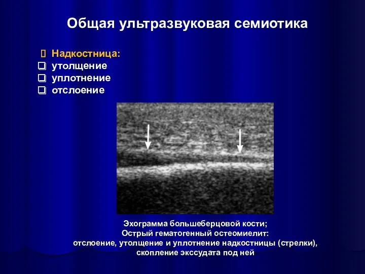 Общая ультразвуковая семиотика Надкостница: утолщение уплотнение отслоение Эхограмма большеберцовой кости;