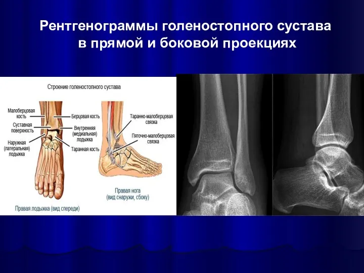 Рентгенограммы голеностопного сустава в прямой и боковой проекциях