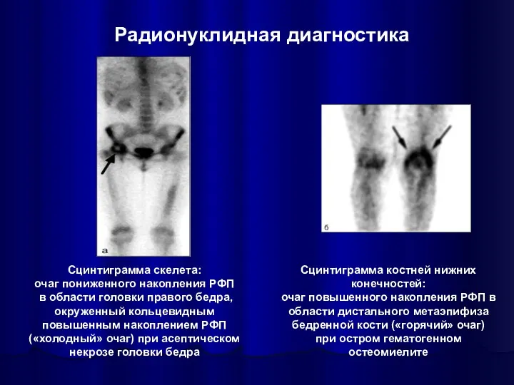 Сцинтиграмма костней нижних конечностей: очаг повышенного накопления РФП в области