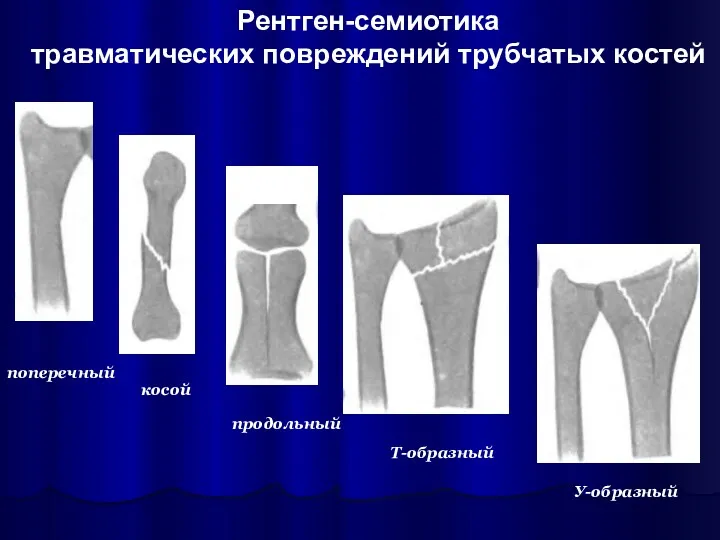 Рентген-семиотика травматических повреждений трубчатых костей поперечный косой продольный Т-образный У-образный