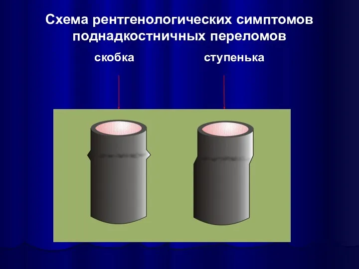 Схема рентгенологических симптомов поднадкостничных переломов скобка ступенька