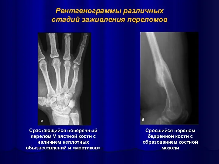 Срастающийся поперечный перелом V пястной кости с наличием неплотных обызвествлений