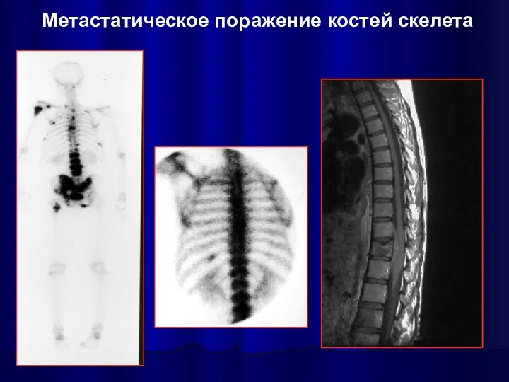 Метастатическое поражение костей скелета