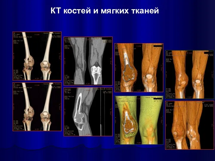 КТ костей и мягких тканей