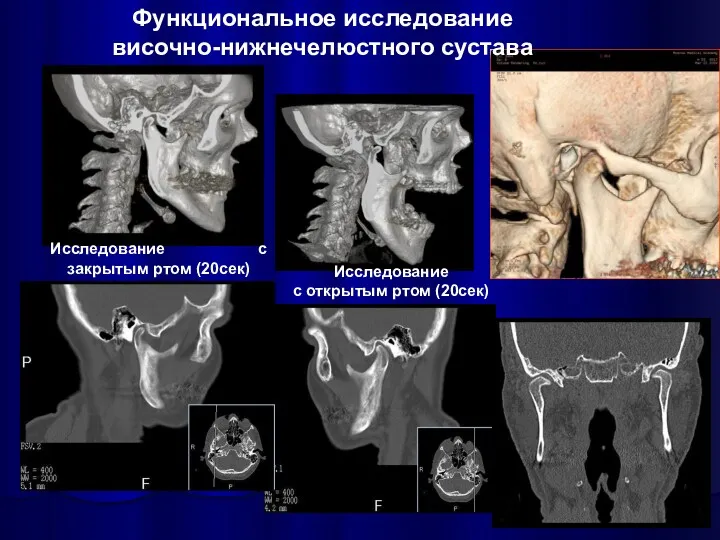 Функциональное исследование височно-нижнечелюстного сустава Исследование с открытым ртом (20сек) Исследование с закрытым ртом (20сек)