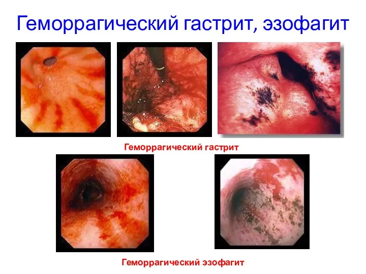 Геморрагический гастрит, эзофагит Геморрагический гастрит Геморрагический эзофагит