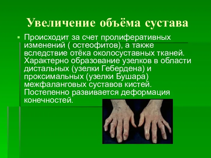 Увеличение объёма сустава Происходит за счет пролиферативных изменений ( остеофитов),