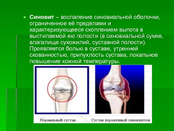 Синовит – воспаление синовиальной оболочки, ограниченное её пределами и характеризующееся