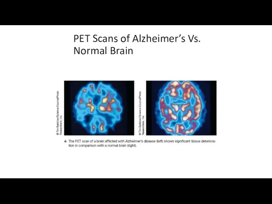 PET Scans of Alzheimer’s Vs. Normal Brain