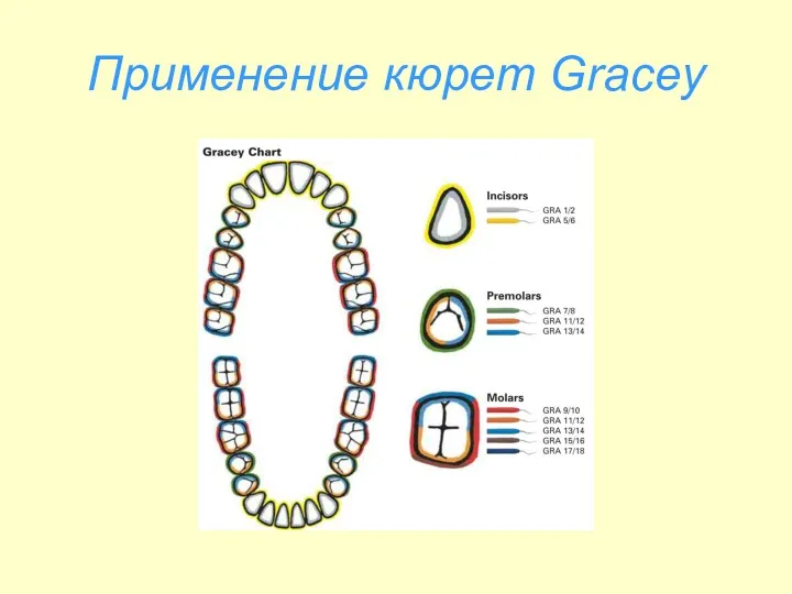 Применение кюрет Gracey