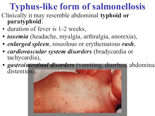 Typhus-like form of salmonellosis Clinically it may resemble abdominal typhoid