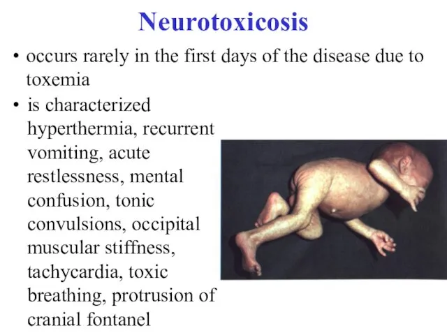 Neurotoxicosis occurs rarely in the first days of the disease