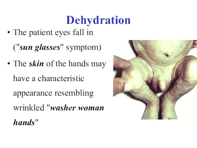 Dehydration The patient eyes fall in ("sun glasses" symptom) The